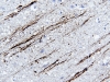 Axonal injury, beta amyloid precursor protein immunohistochemistry